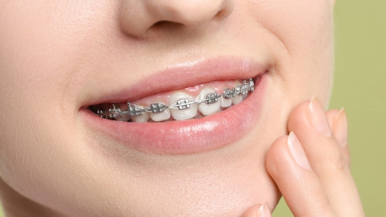 Braces in JB: Types, Prices and What to Expect Before You Start (2026)