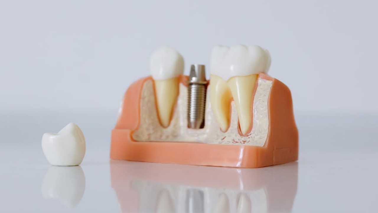 Dental Implants in JB: Everything You Need to Know Before Making the Decision (2026)