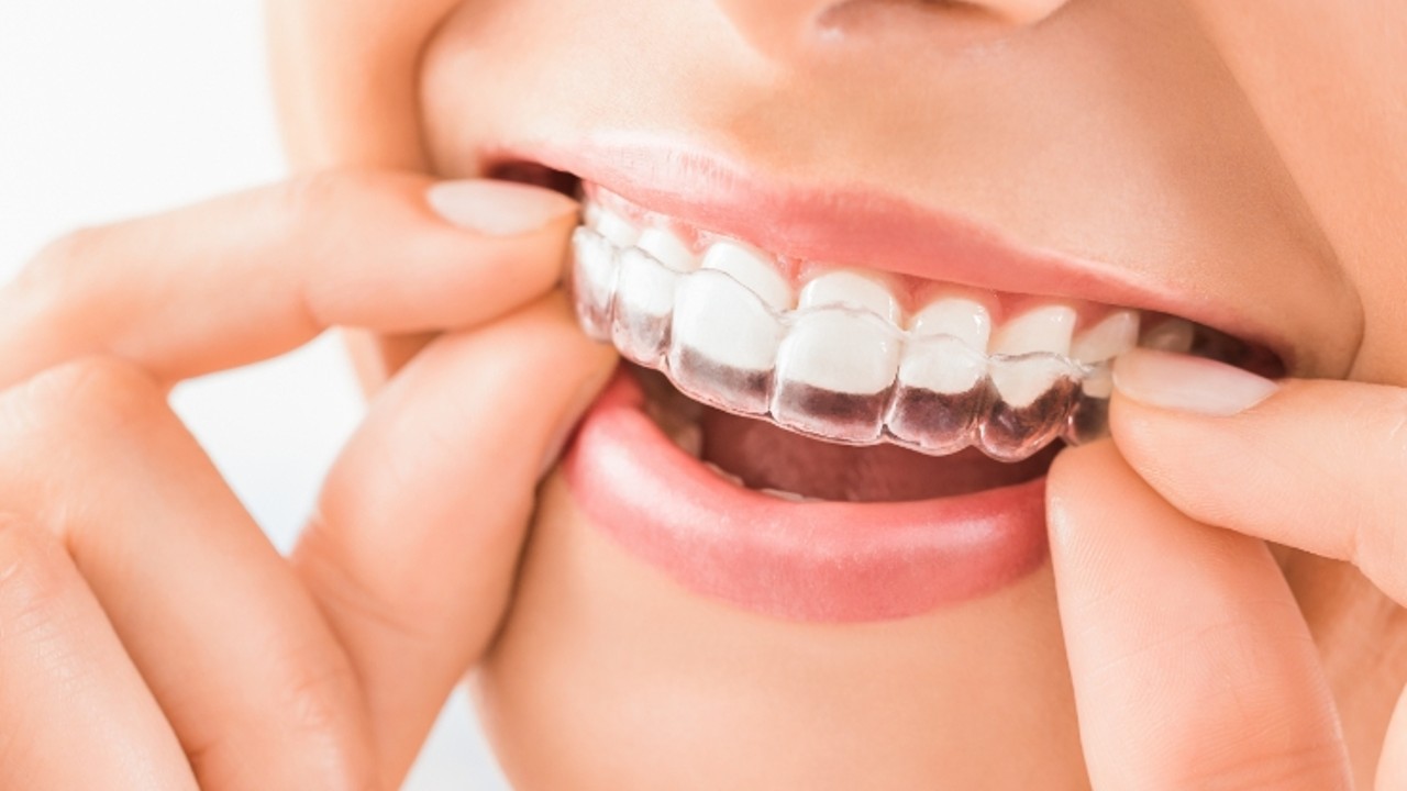 Invisalign in Malaysia 2026: How It Works & Is It Right for You?