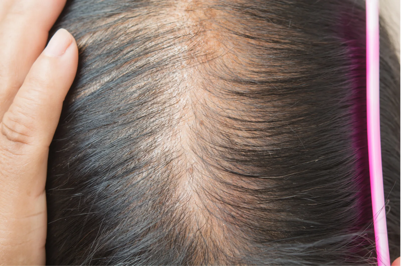 Hair and scalp viewed from above
