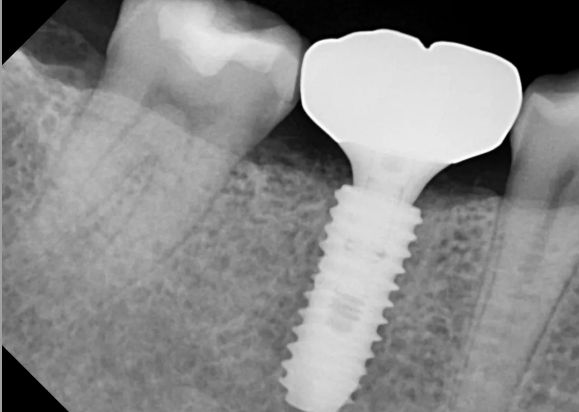 Dental implant