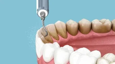 Scaling and polishing