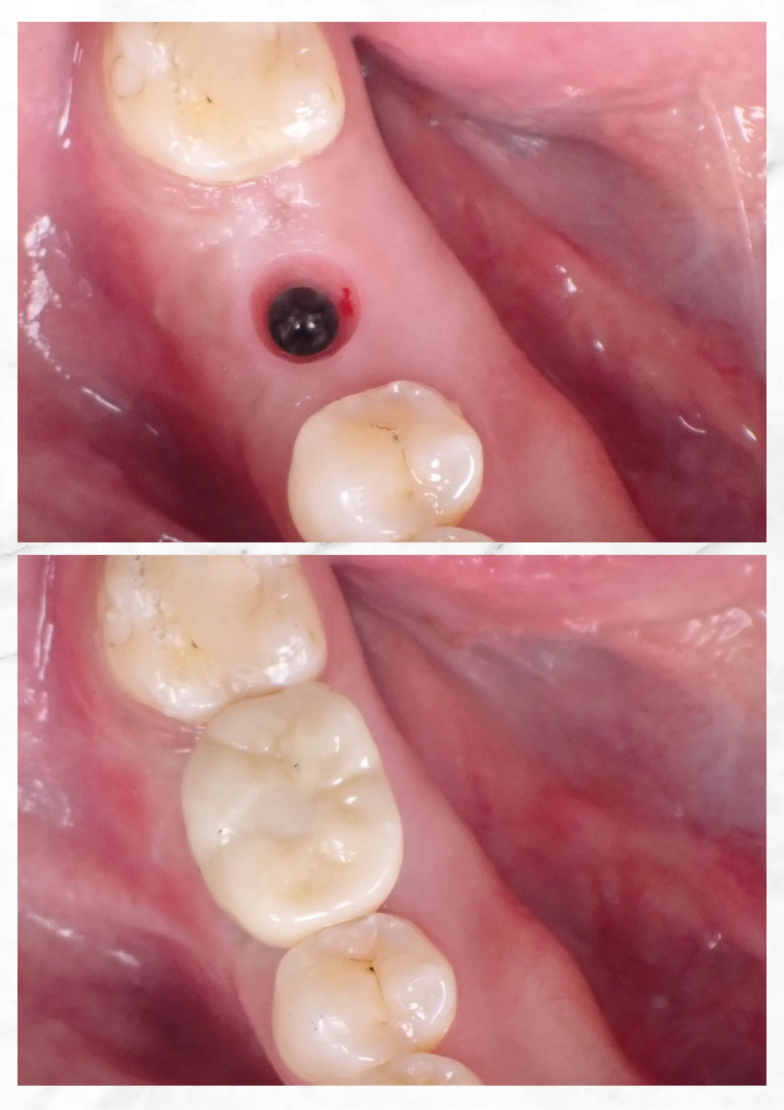 Implant treatment image
