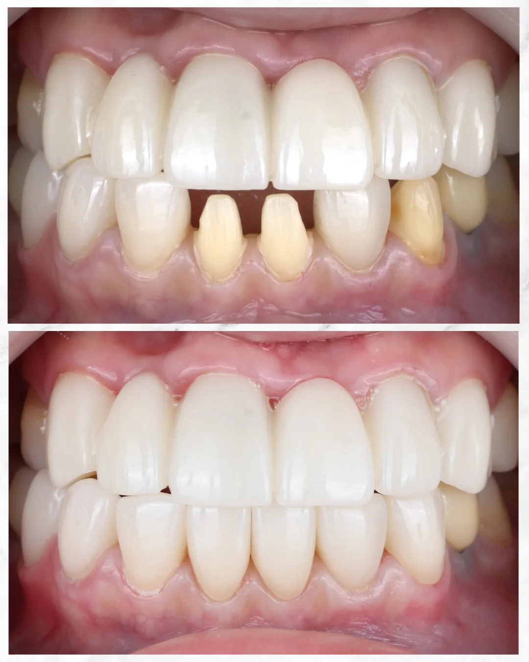 Implant treatment image