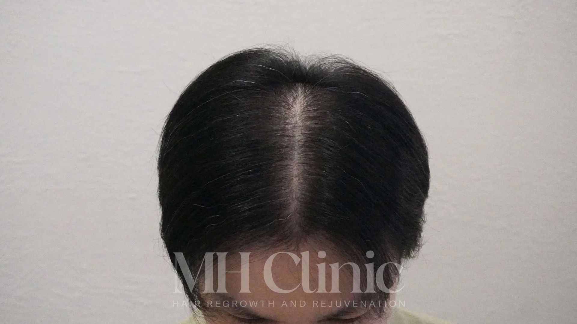 Before treatment image