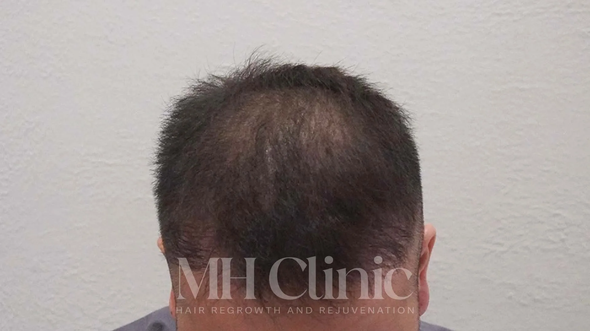 Before treatment image