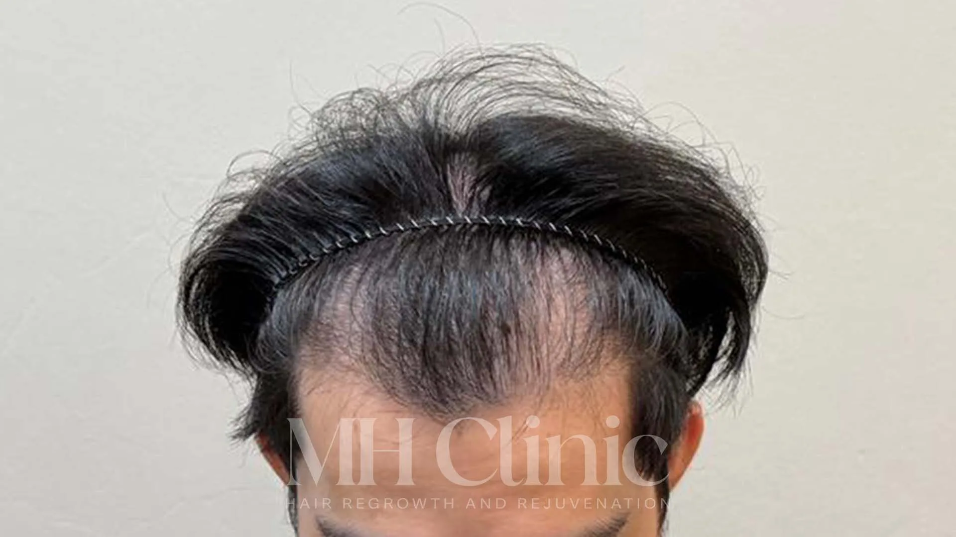 Before treatment image