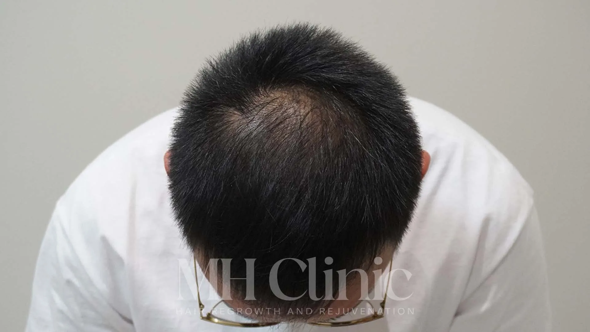 Before treatment image