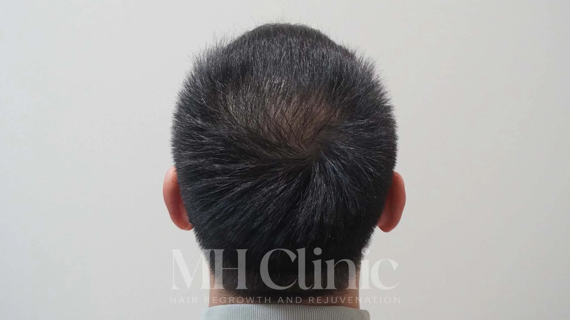 Before treatment image
