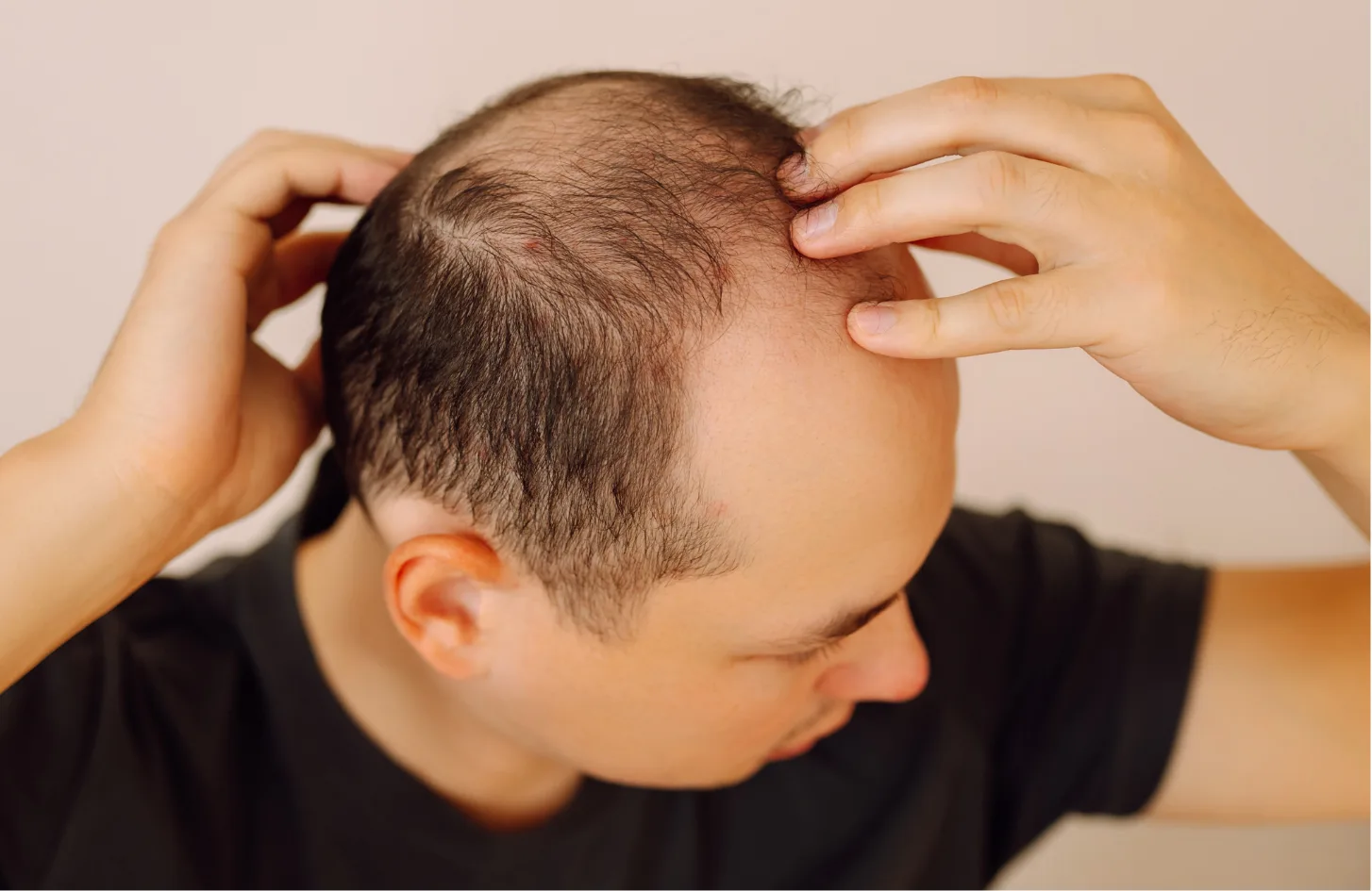 Hair loss for men